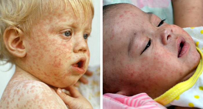 measles-update